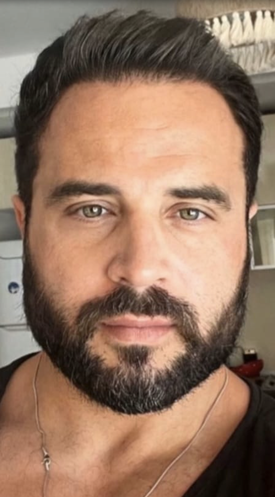 Po transplantácii vlasov